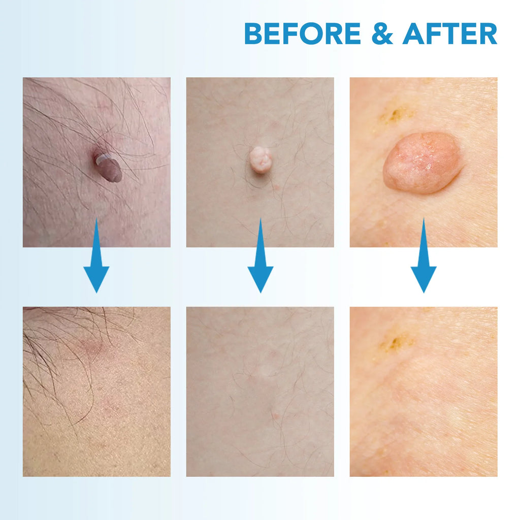 PureDerm™ - Skin tag remover pen